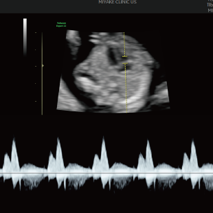 胎児ドックの様子_初期