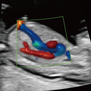 胎児ドックの様子_初期