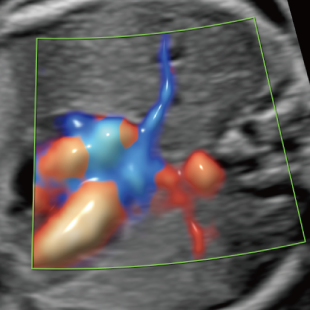 胎児ドックの様子_中期_心臓
