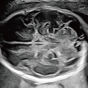 胎児ドックの様子_後期_頭