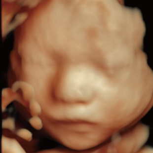 胎児ドックの様子_後期_4D